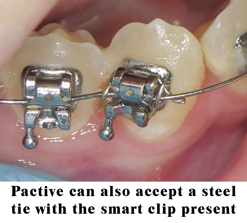 self ligating bracket with a steel tie 