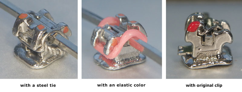 How to remove the clip the self ligating bracket 