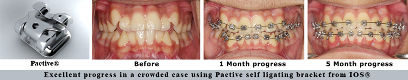 Self ligating bracket before and after USA Pactive Damon 