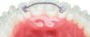 Picture of Lingual Retainers 2&2 16 mm - PK/2